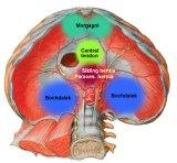 Hernia diaphragmatica