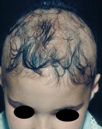 Side effects of steroid cream for alopecia