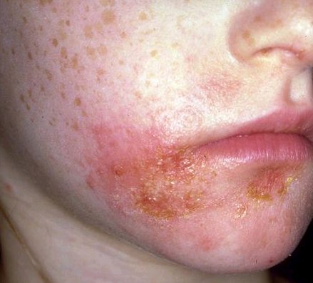 Skin Disorder: Pityriasis Alba - Description, Treatment