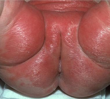 pics of oral thrush