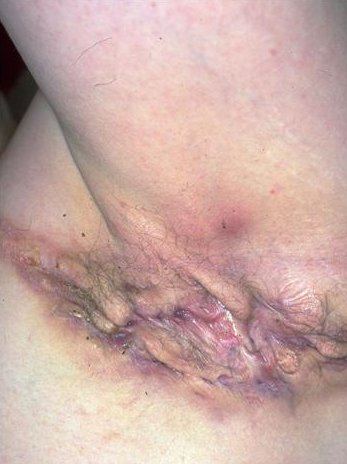 Hidradenitis