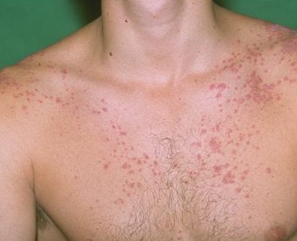 Psoriasis guttate type