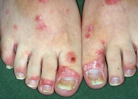 Psoriasis guttate type