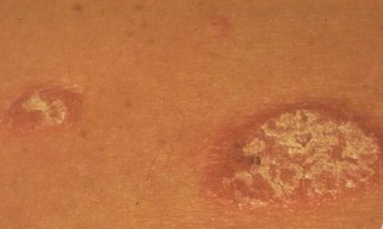 Psoriasis guttate type