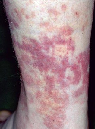 Urticaria