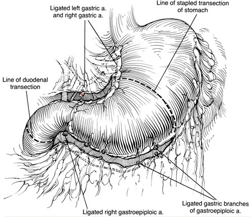 Figuur 1 Subtotale gastrectomie