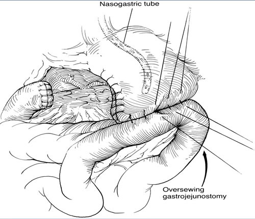 Figuur 2 Subtotale gastrectomie. met Billroth II reconstructie 
