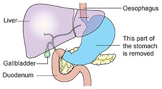 Figuur 2 Totale gastrectomie met Roux-enY reconstructie 