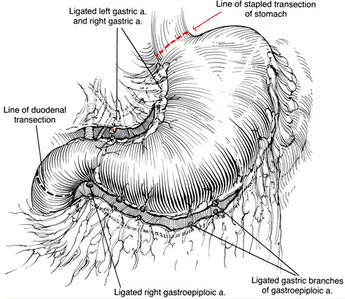 Figuur 1 Totale gastrectomie. 