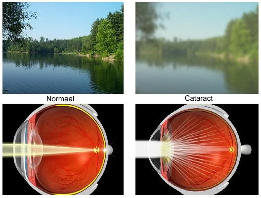 Cataract (Bron: www.cataractinstitute.net)