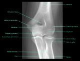 Anatomie:schouder,arm,elleboog,onderarm,pols,vinger,scapula,humerus,olecranon,radius,ulna,scaphoid,naviculare,metacarpus,falanx,phalanx,carpusnervus medianus,nervus axillaris,nervus radialis.