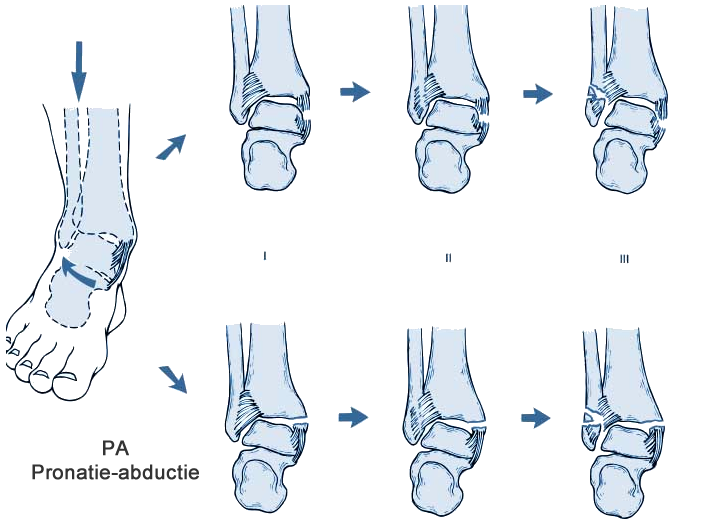 Enkelfractuur Lauge-Hansen supinatie-eversie