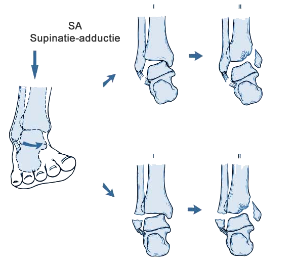 Enkelfractuur Lauge-Hansen supinatie-eversie