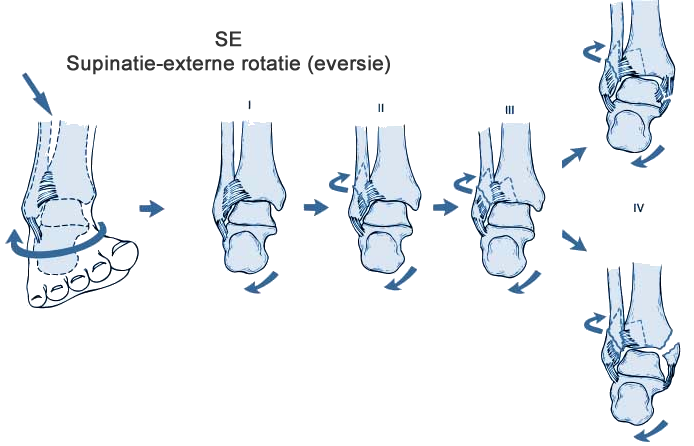 Enkelfractuur Lauge-Hansen supinatie-eversie