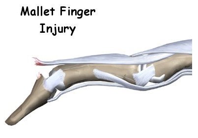 Mallet Finger