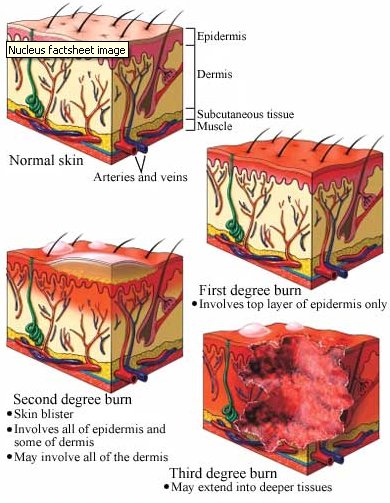 partial thickness wounds