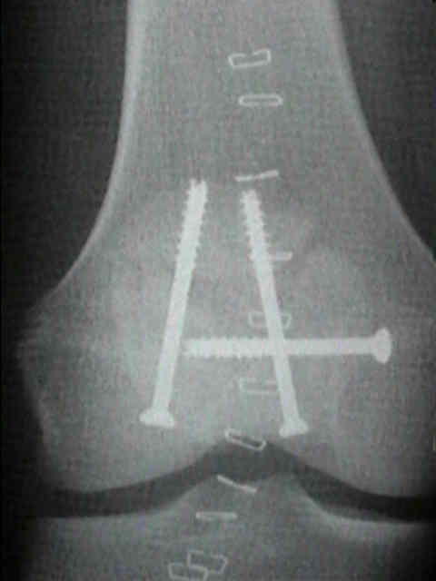 Patellafractuur