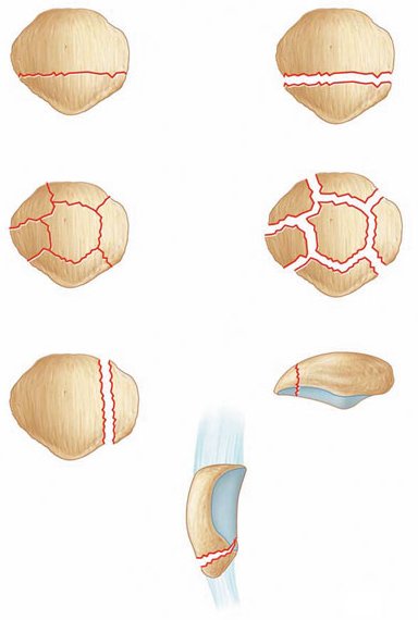 Patellafractuur