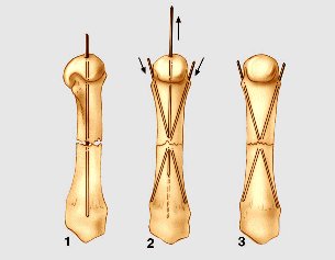 K-draadfixatie ("Eiffeltower") phalanxfractuur